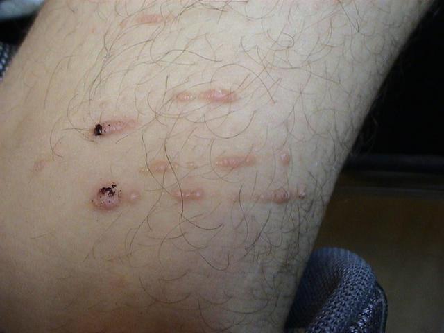 VIRAL INFECTIONS - Warts VIRAL INFECTIONS - Warts