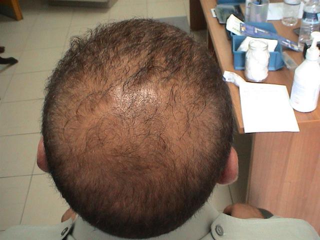 HAIR DISEASES - Androgenetic alopecia