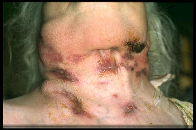 TUBERCULOSIS - Scrofuloderma