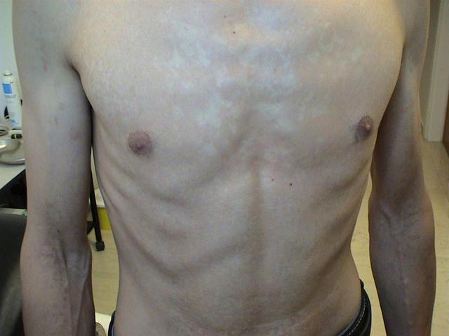 SUPERFICIAL FUNGAL INFECTIONS - Pityriasis versicolor SUPERFICIAL FUNGAL INFECTIONS - Pityriasis versicolor