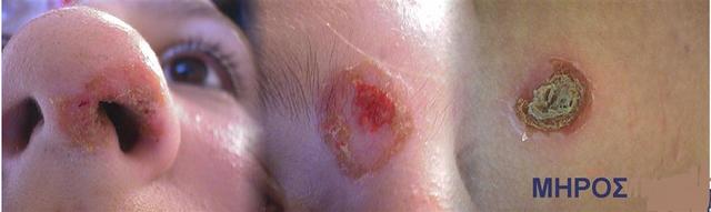 BACTERIAL INFECTIONS - Impetigo