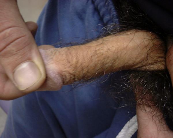 HAIR DISEASES - Hypertrichosis of penis