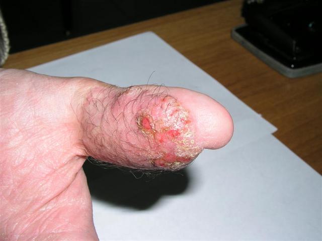 DERMATITIS - EKZEMA - Dermatitis DERMATITIS - EKZEMA - Dermatitis