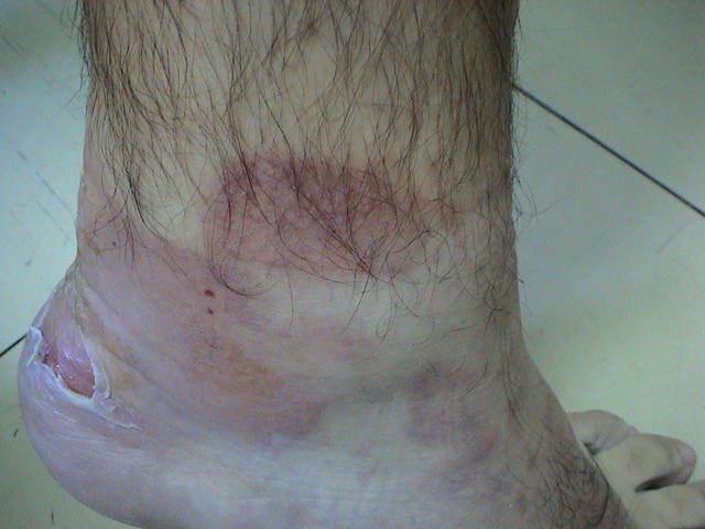 DERMATITIS - EKZEMA - Allergic Contact Dermatitis DERMATITIS - EKZEMA - Allergic Contact Dermatitis