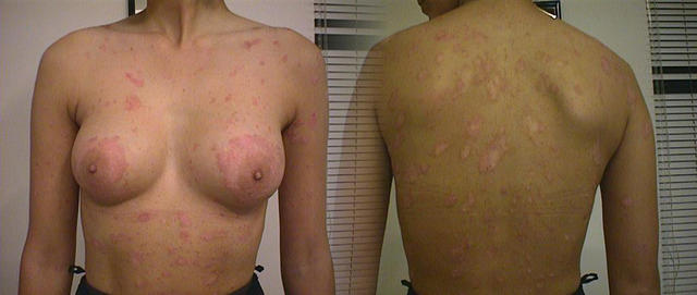 PSORIASIS - Psoriasis