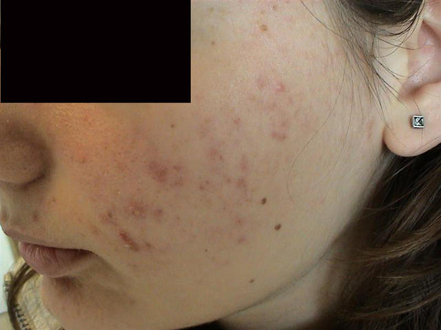 DISEASES OF THE SEBACEOUS GLANDS - Acne vulgaris DISEASES OF THE SEBACEOUS GLANDS - Acne vulgaris