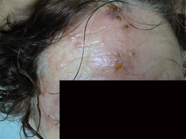 VIRAL INFECTIONS - Herpes Zoster