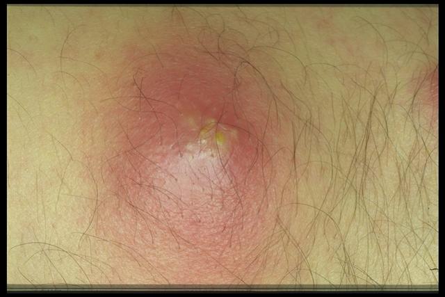 BACTERIAL INFECTIONS - Furunculosis BACTERIAL INFECTIONS - Furunculosis