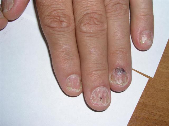 NAIL DISEASES - Lichen planus of the nails