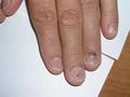 NAIL DISEASES - Lichen planus of the nails