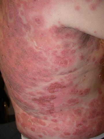 BULLOUS DISEASES - Pemphigus foliaceus