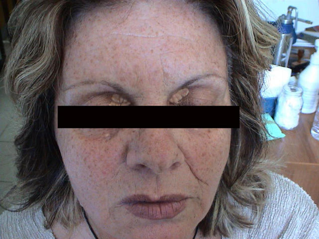 CONNECTIVE TISSUE DISORDERS - Photoaging CONNECTIVE TISSUE DISORDERS - Photoaging