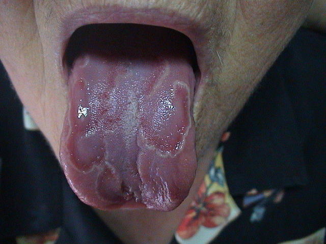 MUCOSAL LESIONS - Geographical tongue MUCOSAL LESIONS - Geographical tongue