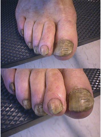 NAIL DISEASES - Onychomycosis