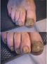 NAIL DISEASES - Onychomycosis