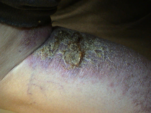DERMATITIS - EKZEMA - Infected eczema DERMATITIS - EKZEMA - Infected eczema