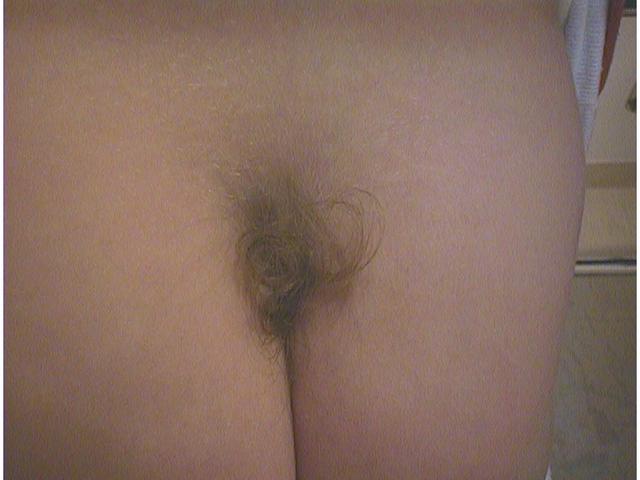 GENODERMATOSES - Faun Tail Nevus GENODERMATOSES - Faun Tail Nevus