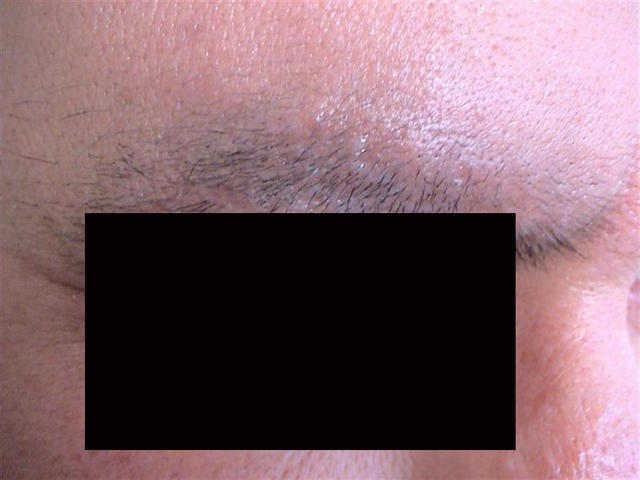 GENODERMATOSES - Netherton syndrome GENODERMATOSES - Netherton syndrome