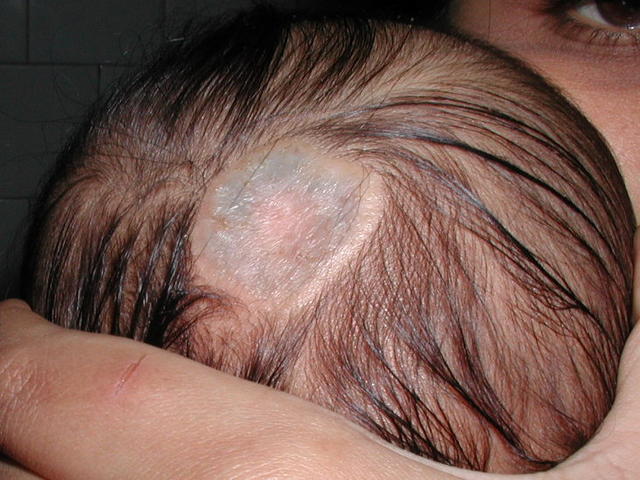 GENODERMATOSES - Aplasia cutis GENODERMATOSES - Aplasia cutis