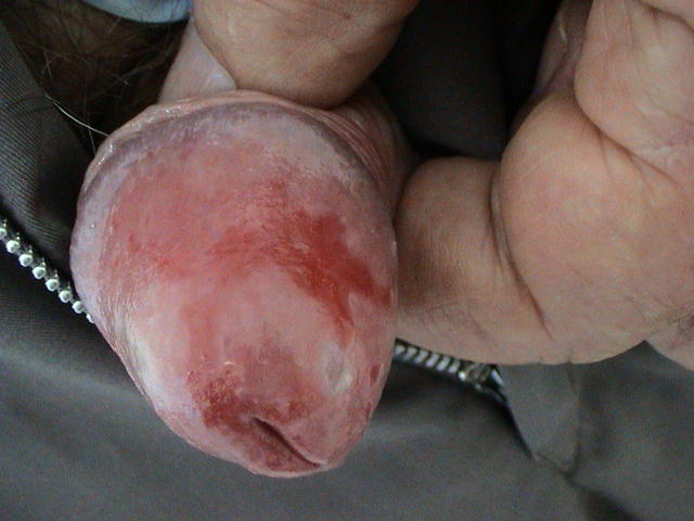 MUCOSAL LESIONS - Plasmacytic valanitis of Zoon