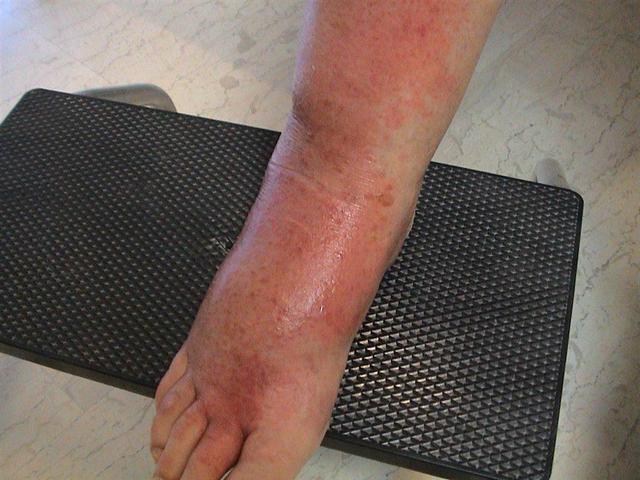 BACTERIAL INFECTIONS - Cellulitis bacterial (streptococcus) BACTERIAL INFECTIONS - Cellulitis bacterial (streptococcus)