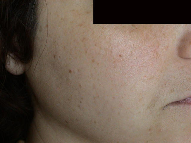 CONNECTIVE TISSUE DISORDERS - Photoaging CONNECTIVE TISSUE DISORDERS - Photoaging