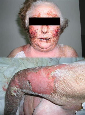 DRUG ERUPTIONS - Toxic epidermal necrolysis due to phenobarbital