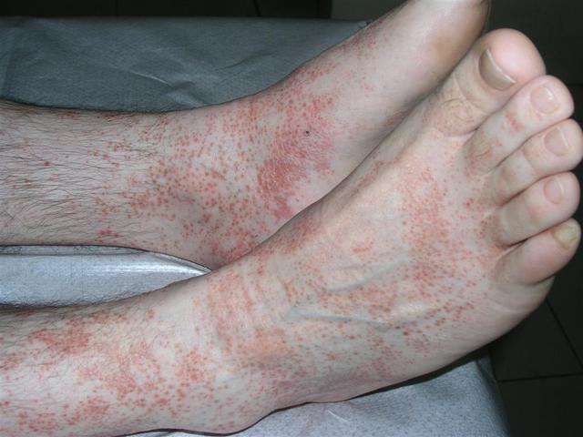 lichenoid dermatitis