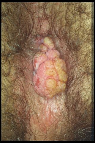 VIRAL INFECTIONS - Condylomata acuminata VIRAL INFECTIONS - Condylomata acuminata