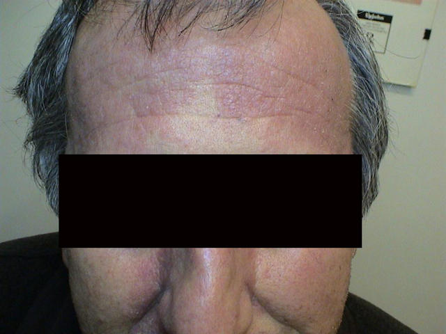 PSORIASIS - Psoriasis of the face