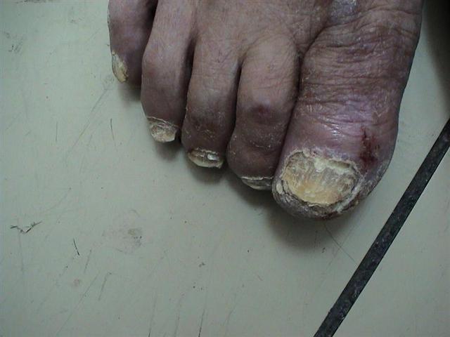 LICHEN - Hypertrophic lichen planus LICHEN - Hypertrophic lichen planus