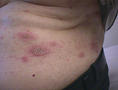 VARIOUS or of UNKNOWN ETIOLOGY DISEASES - Pityriasis rosea