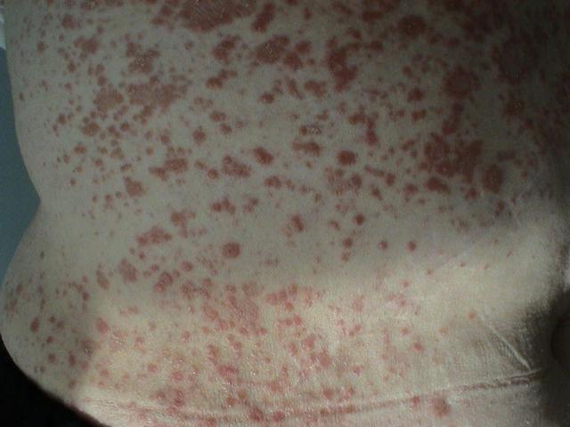 VARIOUS or of UNKNOWN ETIOLOGY DISEASES - Pityriasis rosea VARIOUS or of UNKNOWN ETIOLOGY DISEASES - Pityriasis rosea