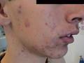 DISEASES OF THE SEBACEOUS GLANDS - Acne, Cystic