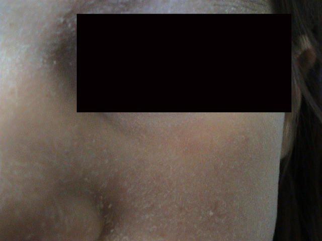 DERMATITIS - EKZEMA - Atopic dermatitis DERMATITIS - EKZEMA - Atopic dermatitis