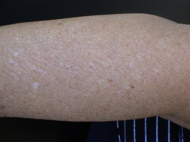 CONNECTIVE TISSUE DISORDERS - Photoaging CONNECTIVE TISSUE DISORDERS - Photoaging