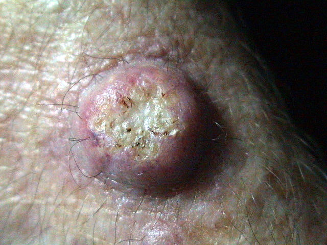 MALIGNANT LESIONS - Keratoacanthoma