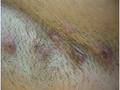 BACTERIAL INFECTIONS - Hidradenitis