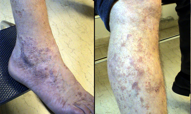 DISEASE OF THE BLOOD AND THE VESSELS – PURPURAS - Eczematoid purpura of Duka-Kapetanaki