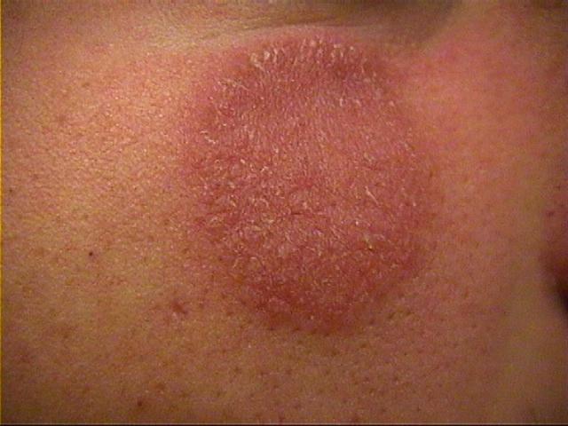 SUPERFICIAL FUNGAL INFECTIONS - Tinea infection from Tr. verrucosum SUPERFICIAL FUNGAL INFECTIONS - Tinea infection from Tr. verrucosum