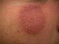 SUPERFICIAL FUNGAL INFECTIONS - Tinea infection from Tr. verrucosum