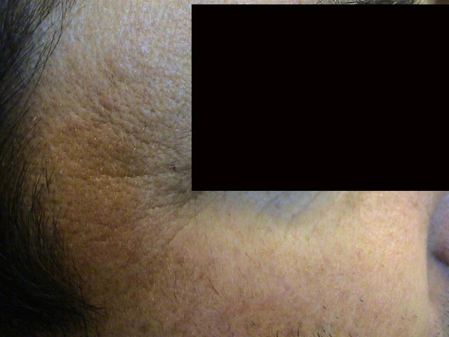 CONNECTIVE TISSUE DISORDERS - Photoaging CONNECTIVE TISSUE DISORDERS - Photoaging