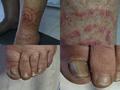 SUPERFICIAL FUNGAL INFECTIONS - Tinea corporis and onychomycosis due to trichophyton