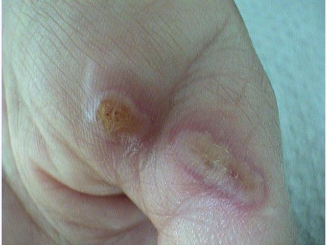 VIRAL INFECTIONS - Orf disease VIRAL INFECTIONS - Orf disease