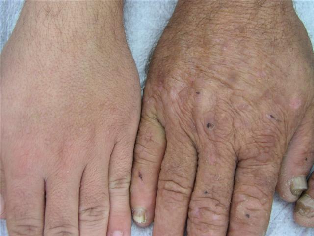 GENODERMATOSES - Acrokeratosis verruciformis of Hopf GENODERMATOSES - Acrokeratosis verruciformis of Hopf