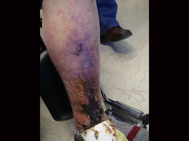 REACTIONS TO HEAT, COLD AND LIGHT - Ulcers, Erythema ab igne REACTIONS TO HEAT, COLD AND LIGHT - Ulcers, Erythema ab igne