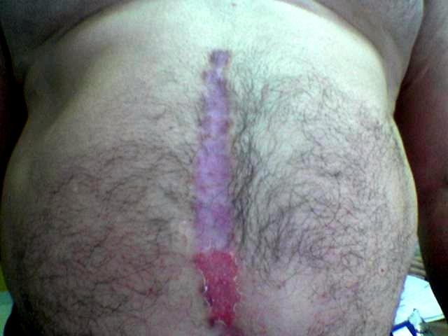 PSORIASIS - Psoriasis PSORIASIS - Psoriasis