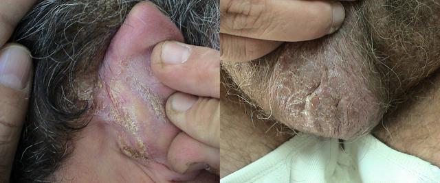 PSORIASIS - Psoriasis PSORIASIS - Psoriasis