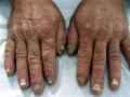 GENODERMATOSES - Acrokeratosis verruciformis of Hopf