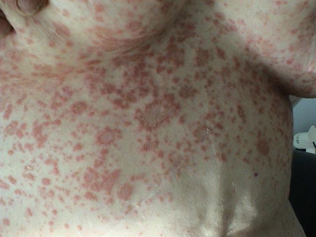 VARIOUS or of UNKNOWN ETIOLOGY DISEASES - Pityriasis rosea VARIOUS or of UNKNOWN ETIOLOGY DISEASES - Pityriasis rosea